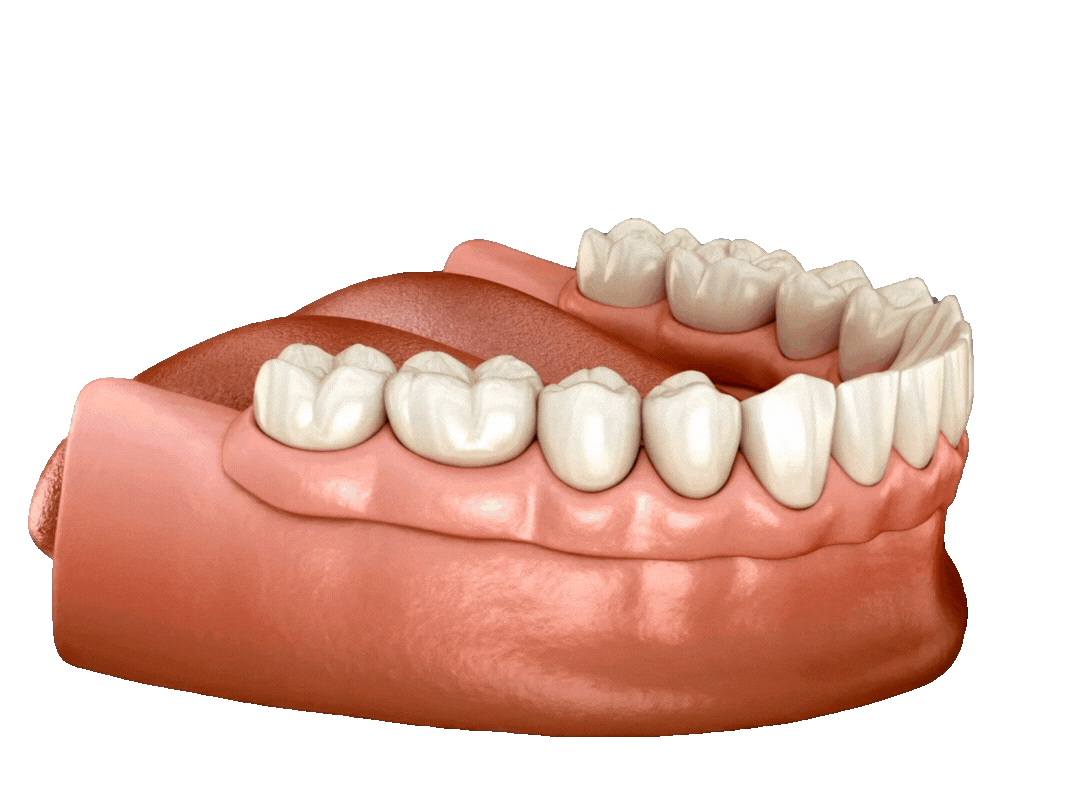 all on 6 dental impents procedure