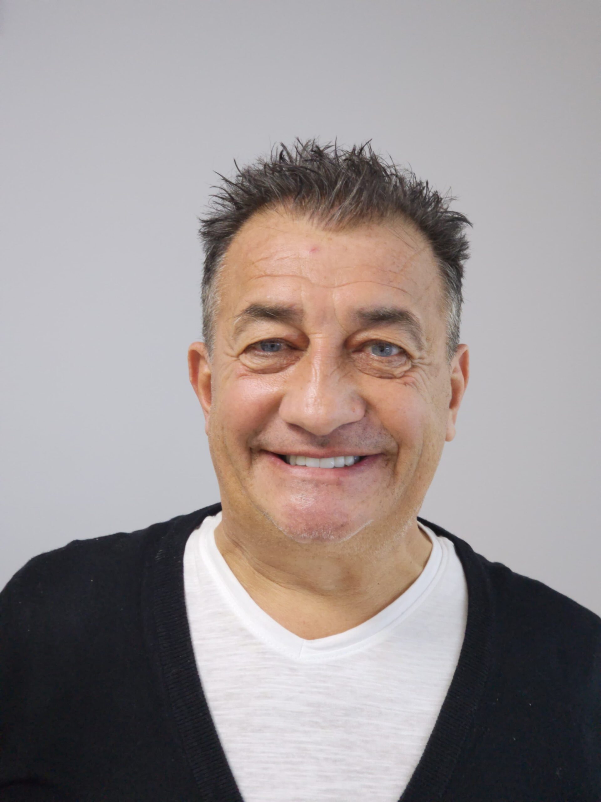 All-on-4 Dental Implants for Full Mouth Restoration in Tirana: Cristian’s Success Story