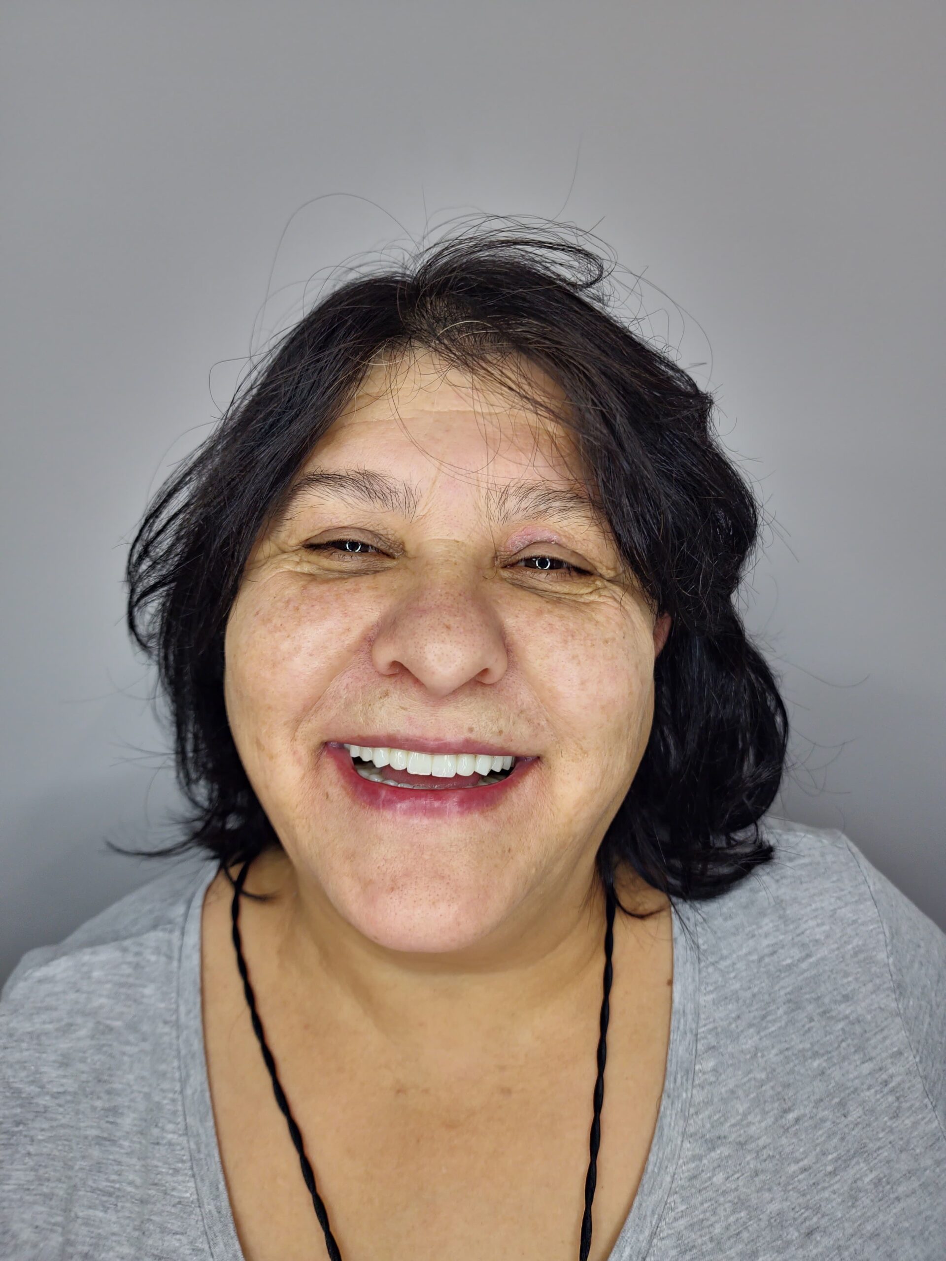 Full Mouth Reconstruction with All-on-6 Dental Implants in Tirana: Structural Jaw Correction for Odeta