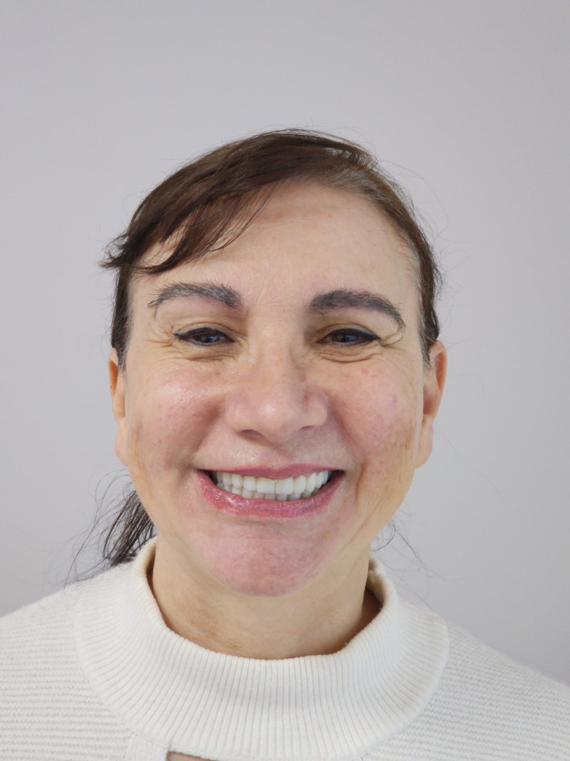 Full Mouth Zirconia Crowns Rehabilitation in Tirana: Advanced Periodontal and Aesthetic Restoration