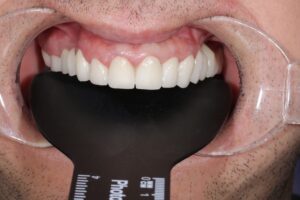 Dentist displaying a natural-looking zirconia dental crown