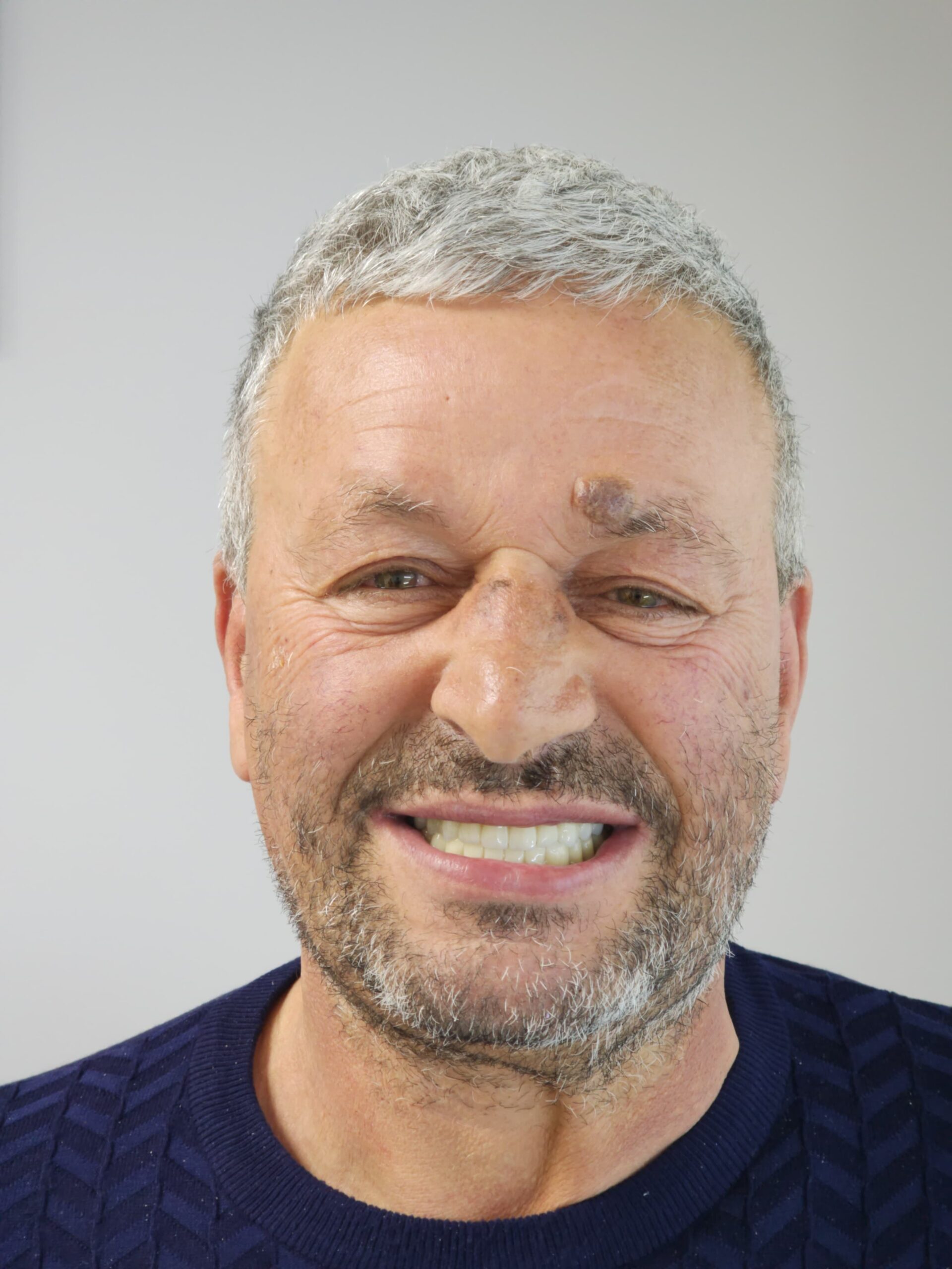 Full-Mouth Implant Rehabilitation with Zirconia Crowns: Complete Case Study