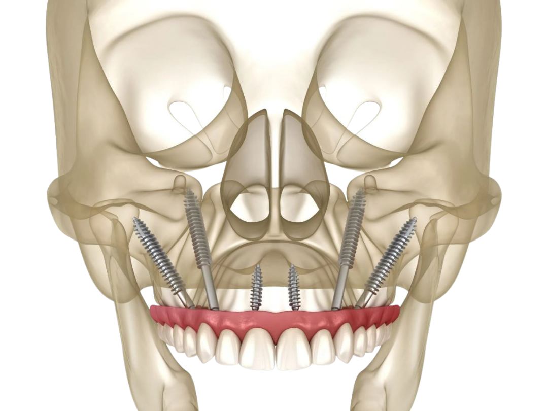 Zygomatic implantology Zygomatic implantology at Tirana Dental Center