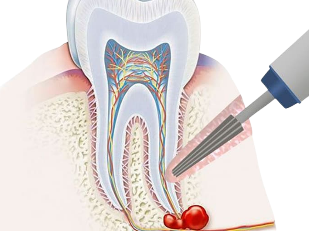 Apical resection Apical resection at Tirana Dental Center
