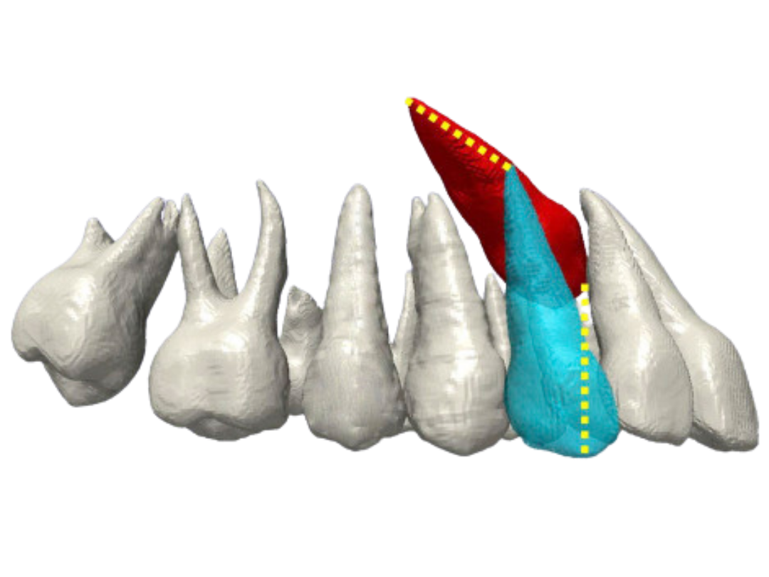 Impacted canines Impacted canines at Tirana Dental Center