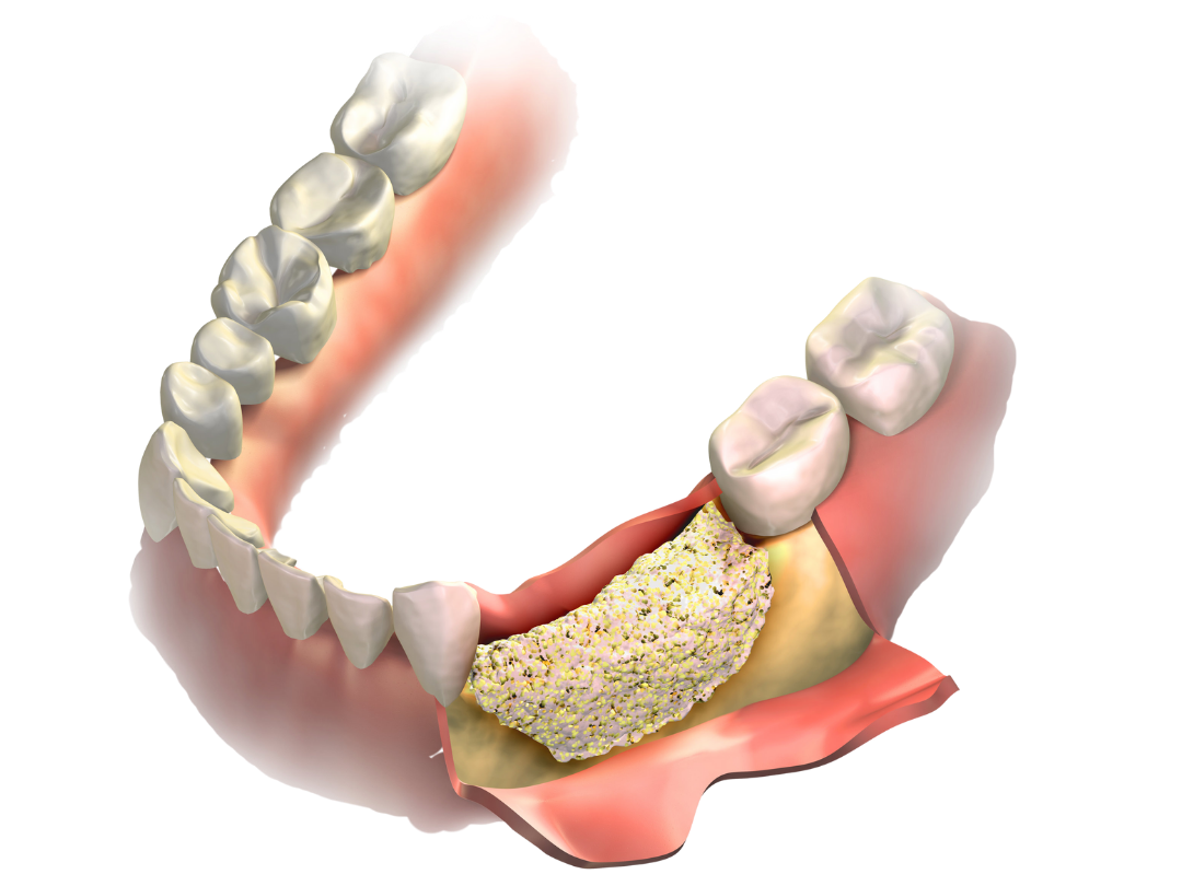 Bone regeneration Bone regeneration at Tirana Dental Center