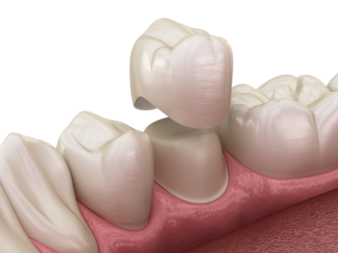 Zirconia crowns Zirconia crowns at Tirana Dental Center
