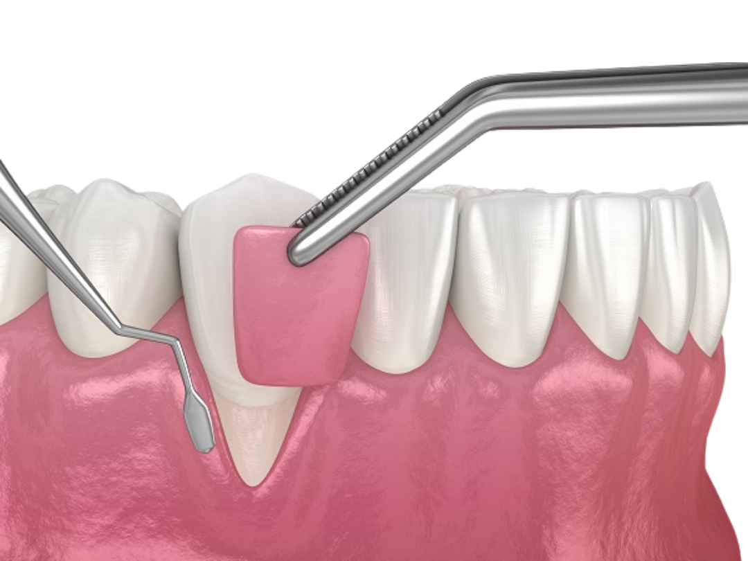 Gum grafting Gum grafting at tirana dental center