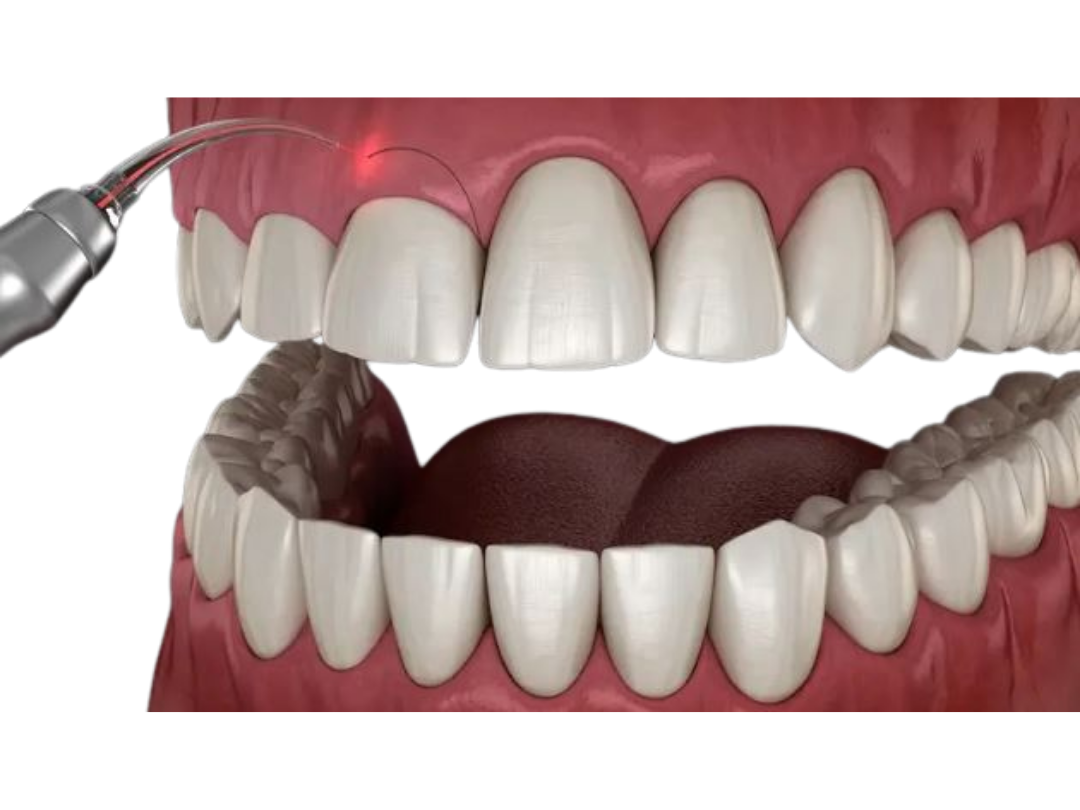 Laser gingivectomy Laser gingivectomy at tirana dental center
