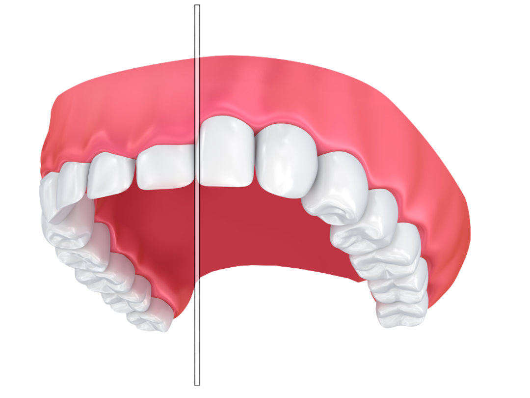 Lip repositioning surgery Lip repositioning surgery at tirana dental center