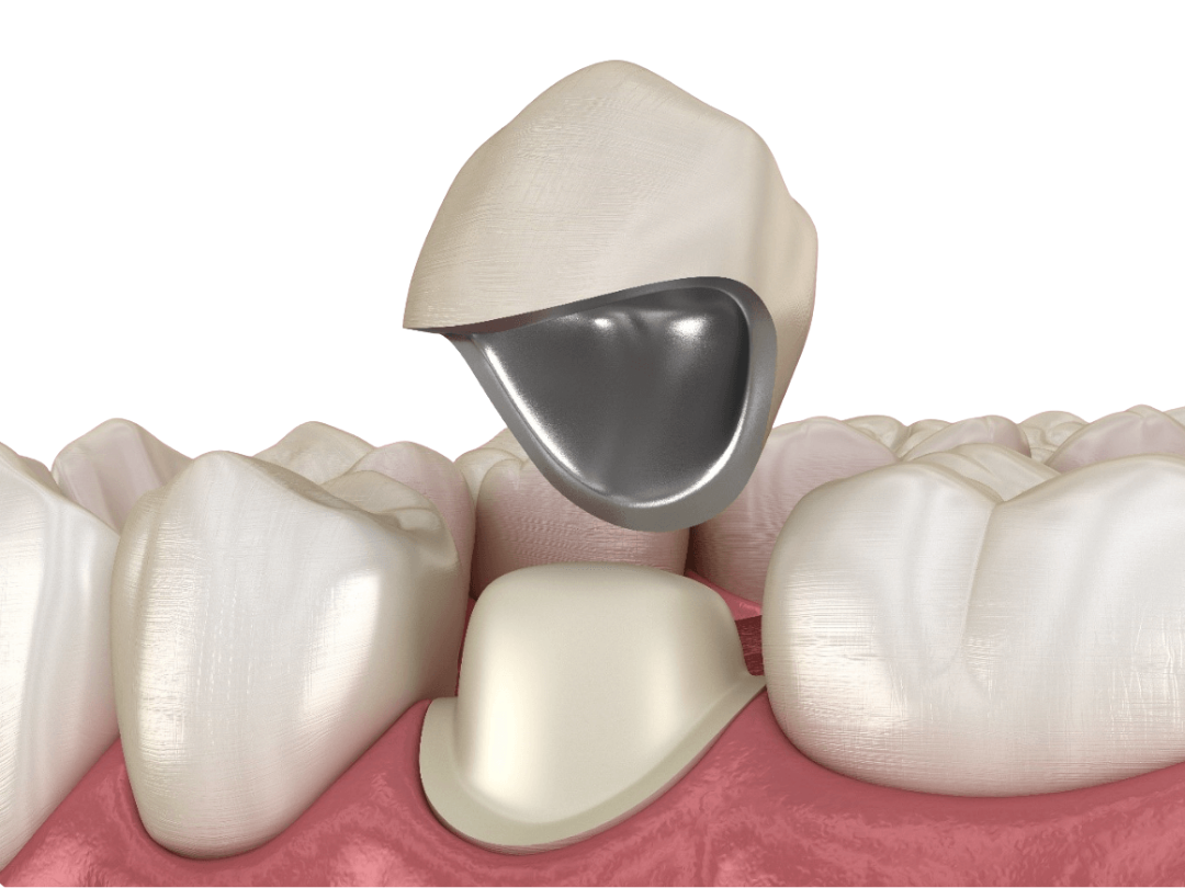 Metal-ceramic crowns Metal-ceramic crowns at tirana dental center