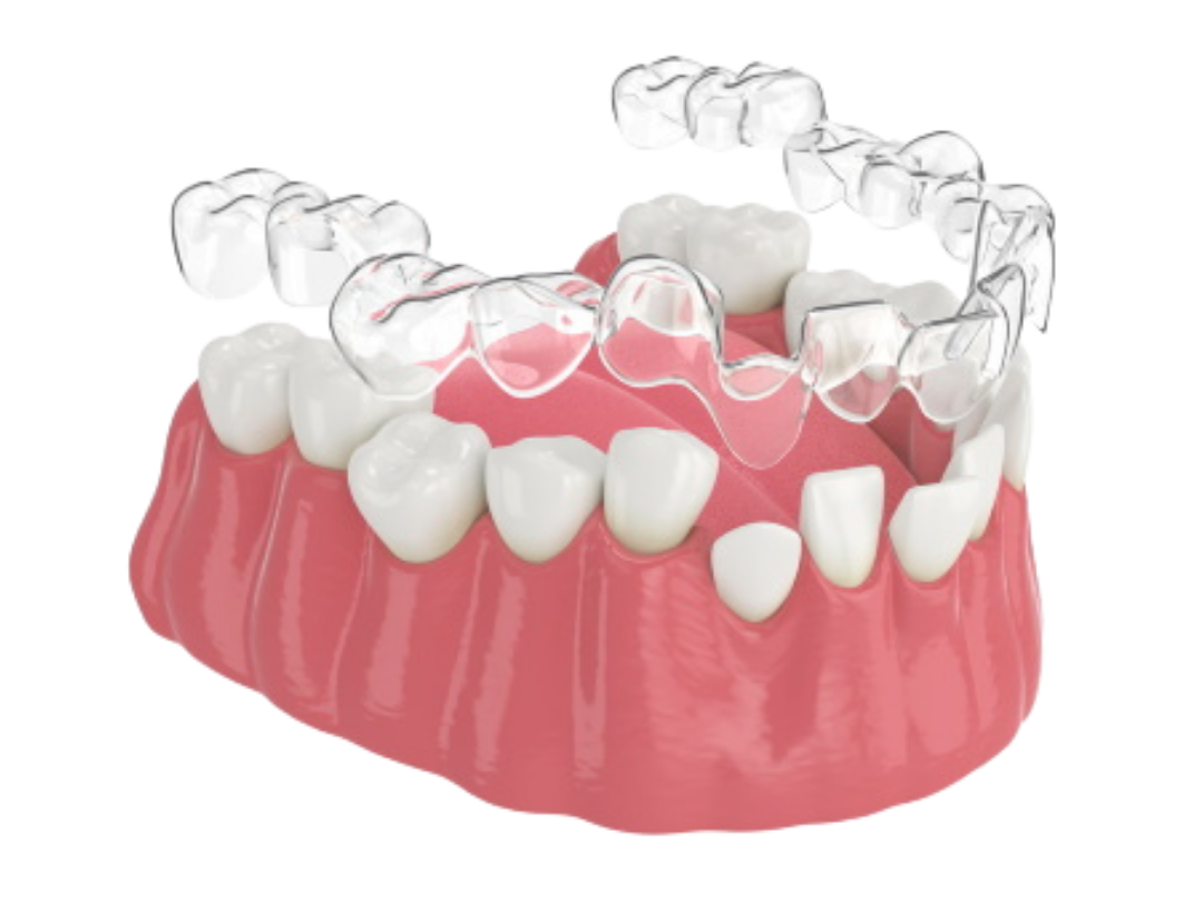 Invisalign Invisalign at tirana dental center