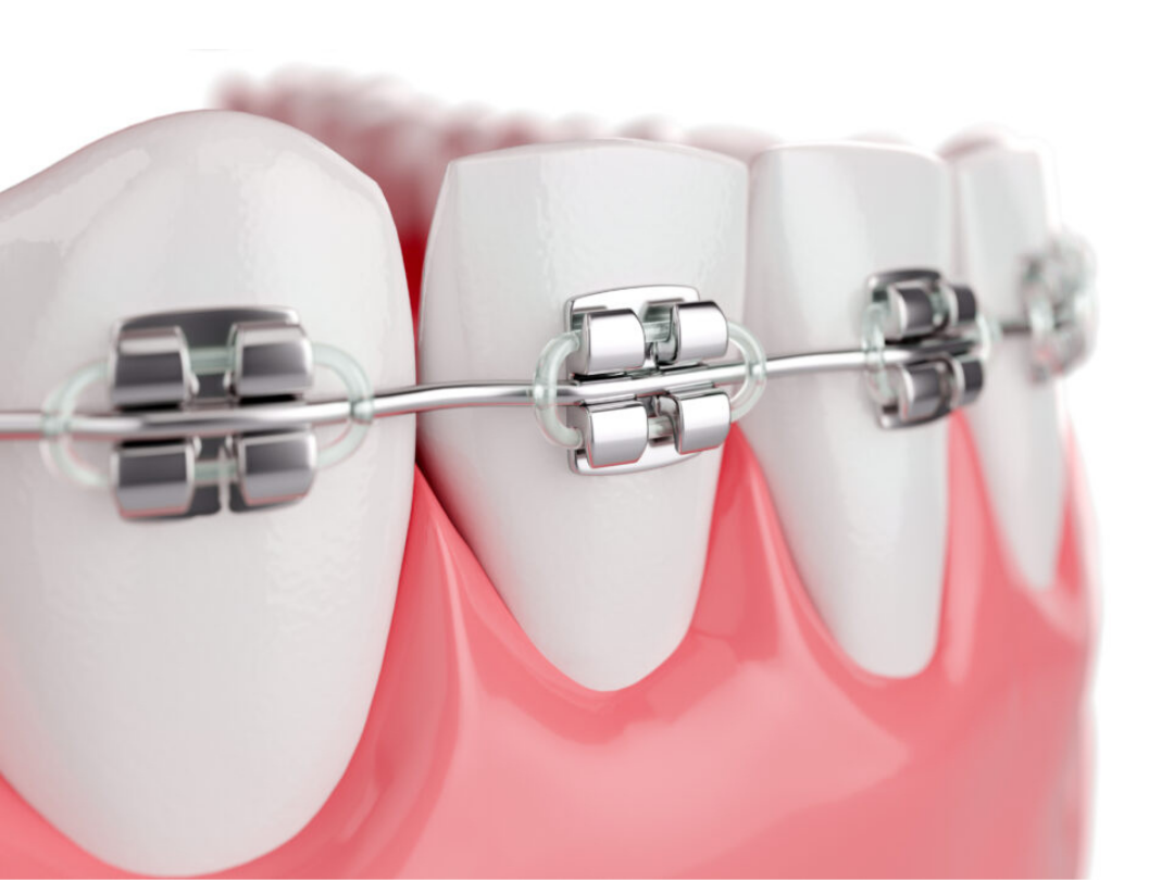 Traditional metal braces Traditional metal braces at tirana dental center