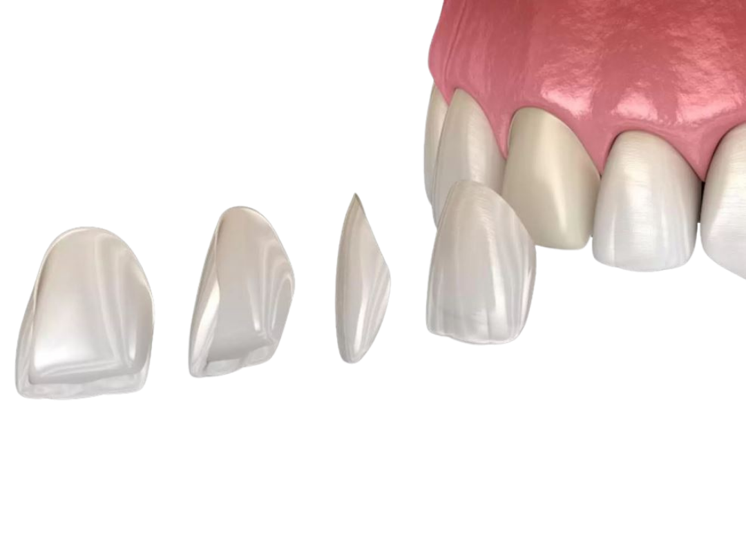 Emax veneers Emax veneers at tirana dental center