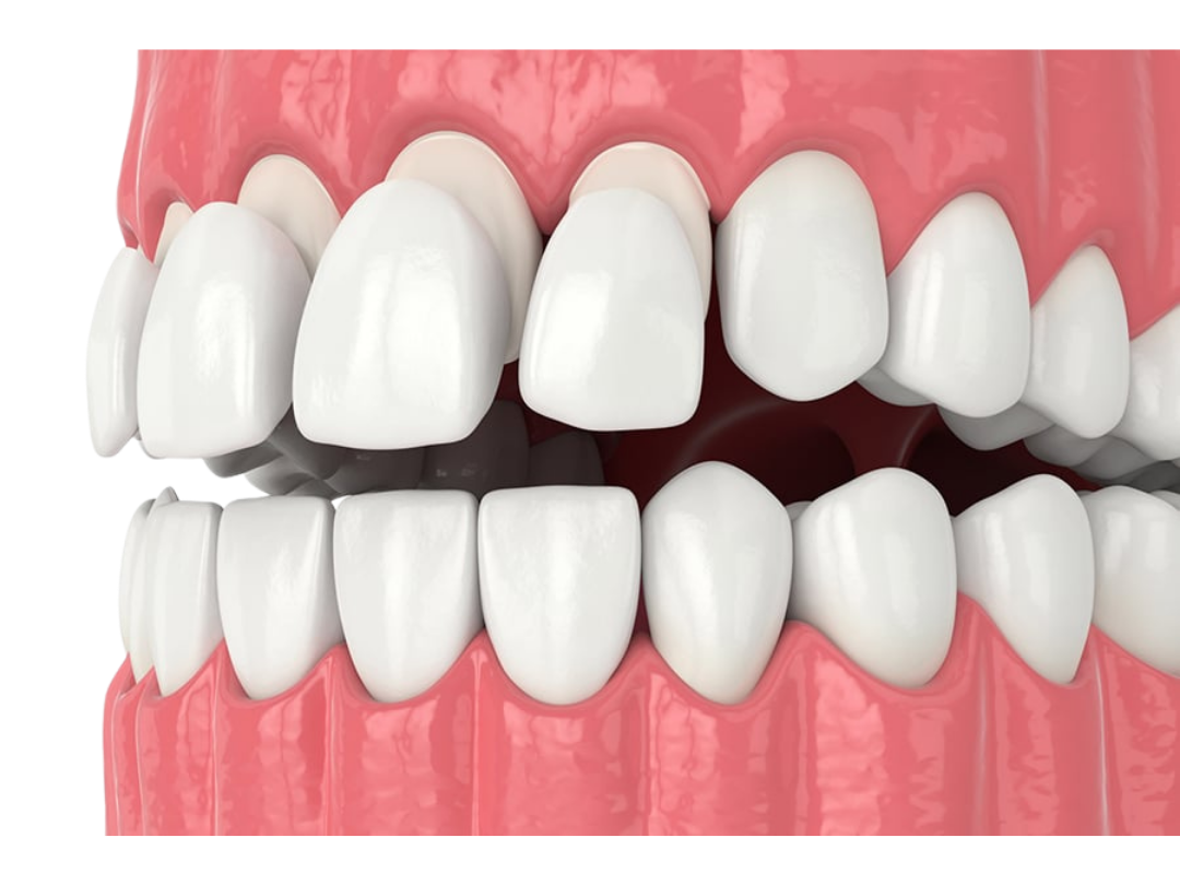 Composite veneers Composite veneers at tirana dental center