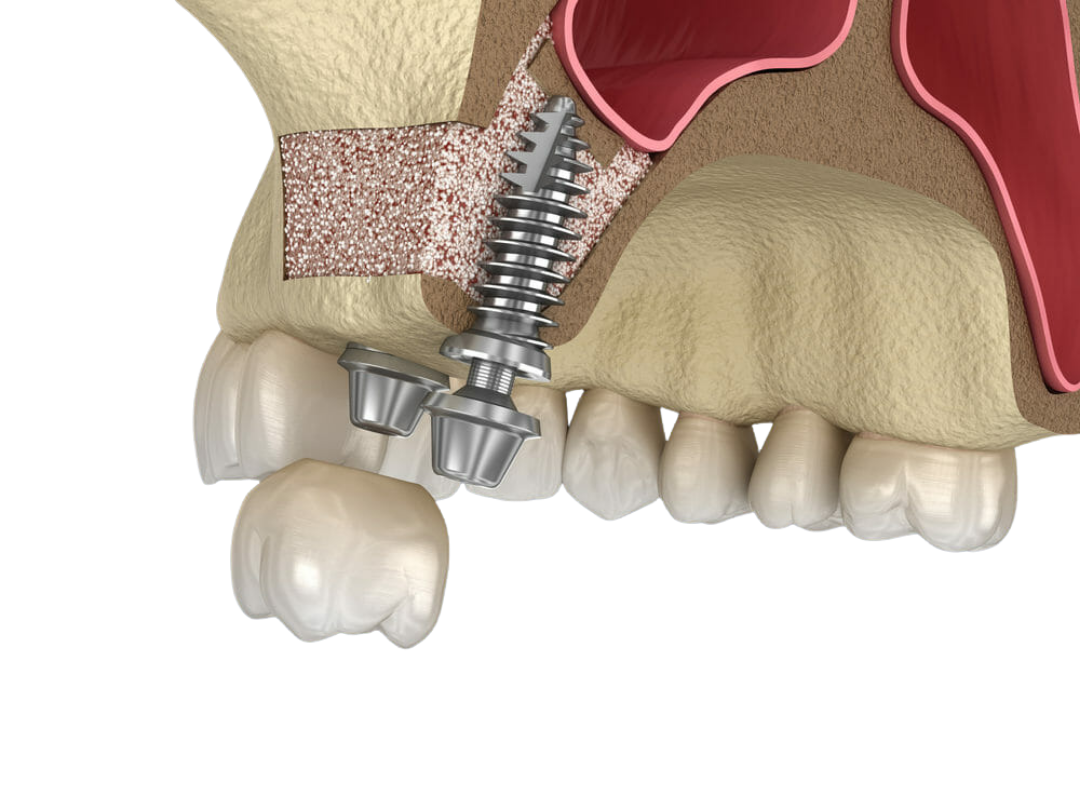 Sinus lift surgery Sinus lift surgery at tirana dental center