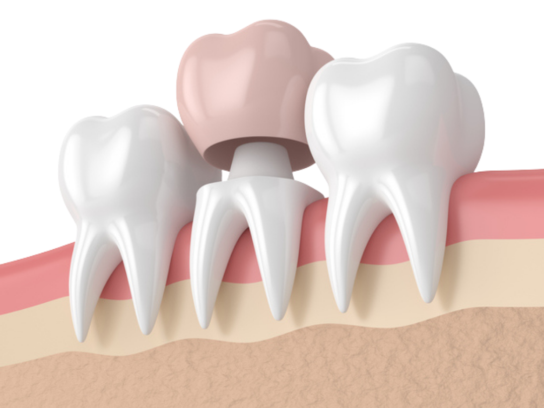Emax Crowns Emax Crowns at Tirana dental center, Albania