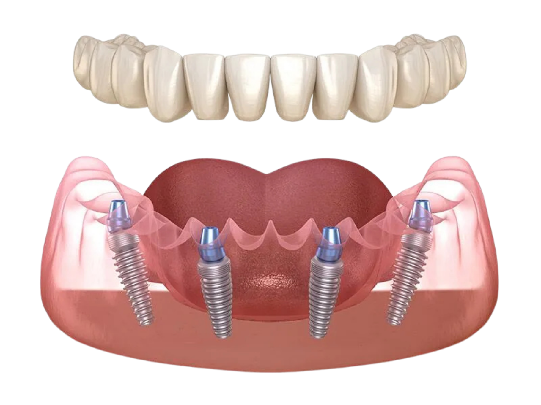 All on 4 All on 4 Dental Implant at Tirana Dental Center, Albania