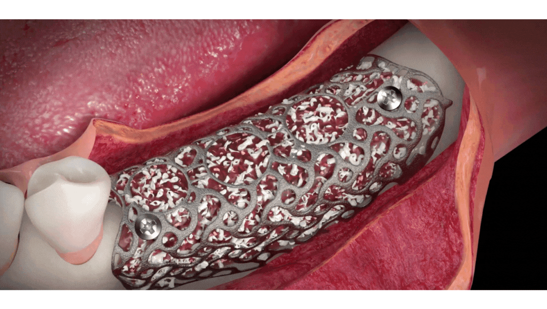 3D animation showing vertical and horizontal bone grafting procedure