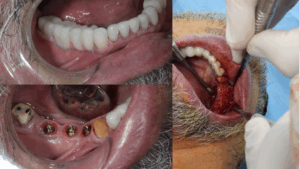 Oral surgeon performing vertical and horizontal bone regeneration surgery