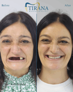 Patient facial transformation after pterygoid implantology treatment showing improved profile and smile