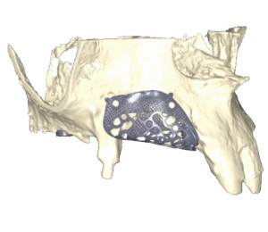 3D dental scan before horizontal and vertical bone augmentation