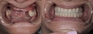 Before and after pterygoid implant restoration showing successful upper jaw rehabilitation