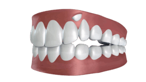 Surgical exposure and extraction of impacted canine tooth at Tirana Dental Center