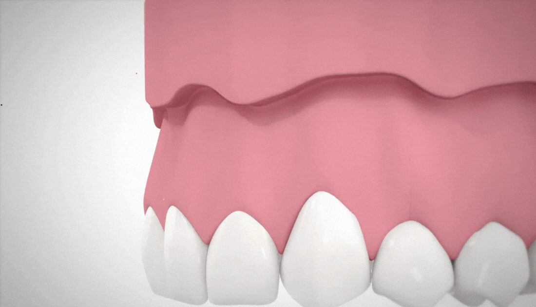 3D animation showing step-by-step apical resection procedure