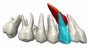 3D dental scan illustrating impacted canine position in upper jaw