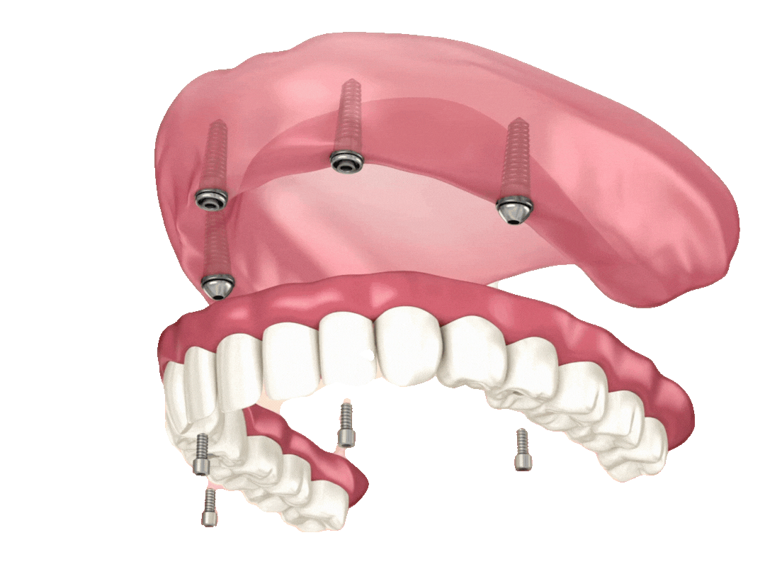 all on 4 dental implant procedure