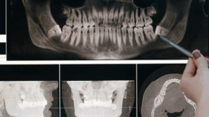 Wisdom teeth X-ray diagnosis at Tirana Dental Center