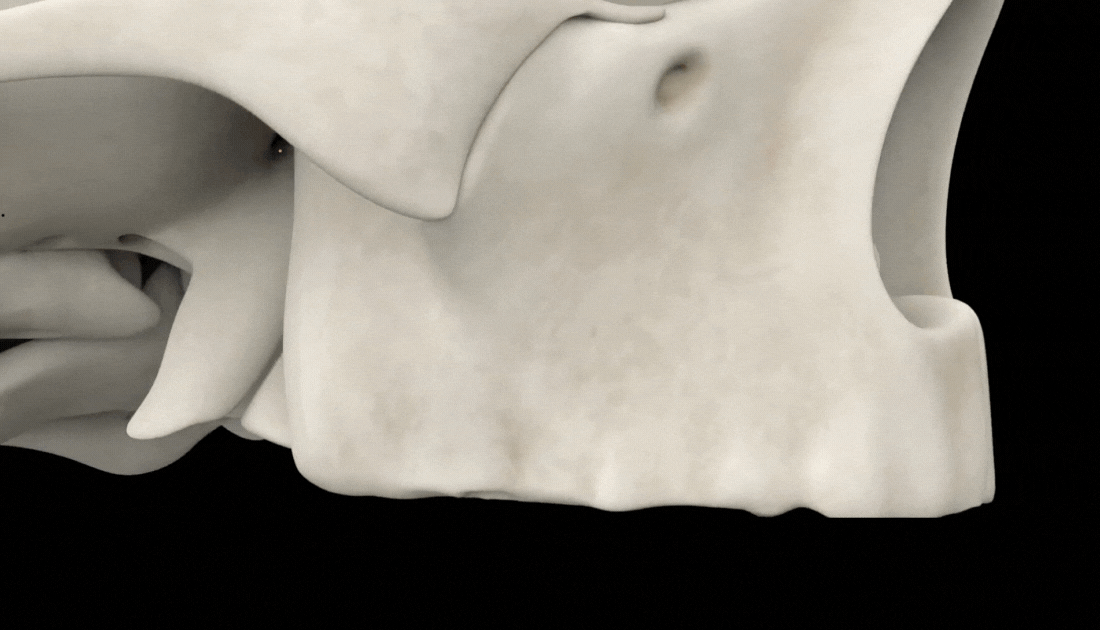 3D visualization of pterygoid implant surgical procedure showing precise implant placement technique