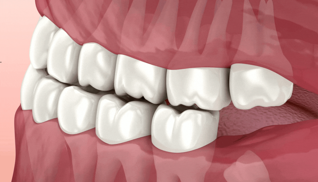 Wisdom teeth removal procedure at Tirana Dental Center by expert oral surgeons