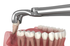 Safe and painless wisdom tooth extraction in Tirana Dental Center, Albania