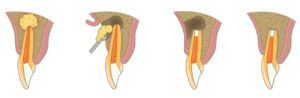 Microsurgical apical root end resection performed by dental specialist
