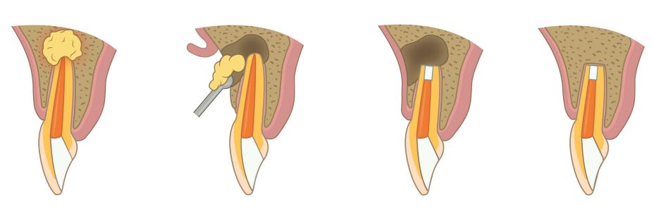 Apical Resection Surgery in Tiran | Dental Specialists