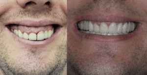 Crown Lengthening before and after at Tirana Dental Center