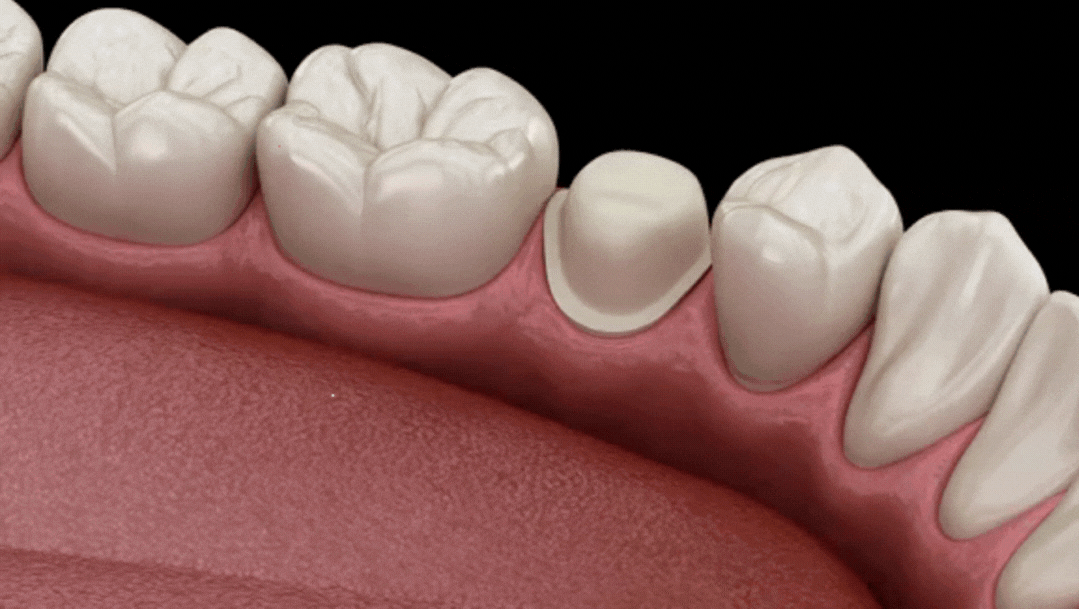 Metal-Ceramic Crowns Explained: 3D Animation