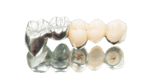 Metal-Ceramic Crowns at Tirana Dental Center, Albania