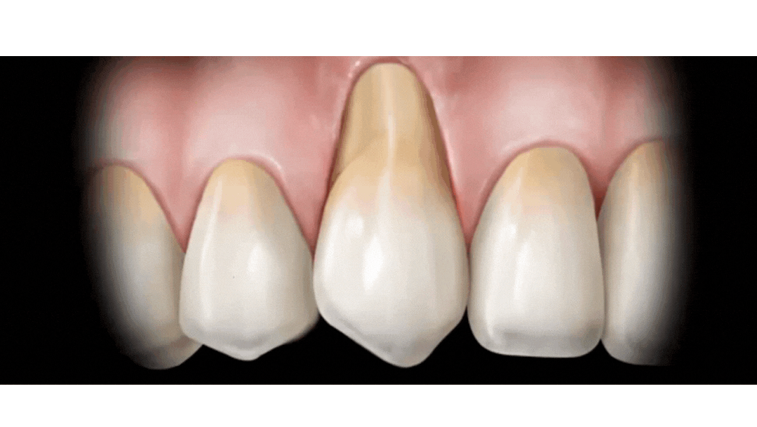 gum grafting 3d animation at tirana Dental Center