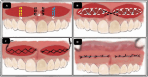 Lip Repositioning Surgery Steps at Tirana Dental Center