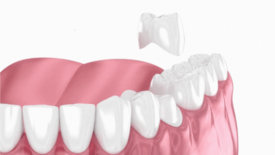 Emax Crowns 3D animation at tirana dental center