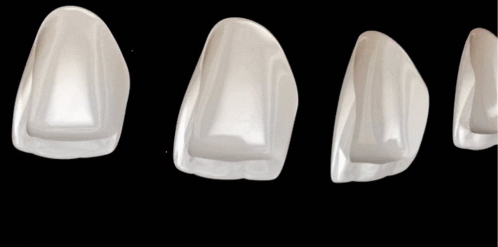 Emax Veneers 3 D animation at tirana dental center