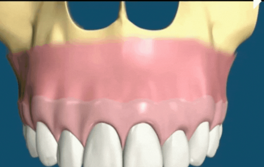 Cystic Lesions Removal Surgery 3D animation tirana dental center