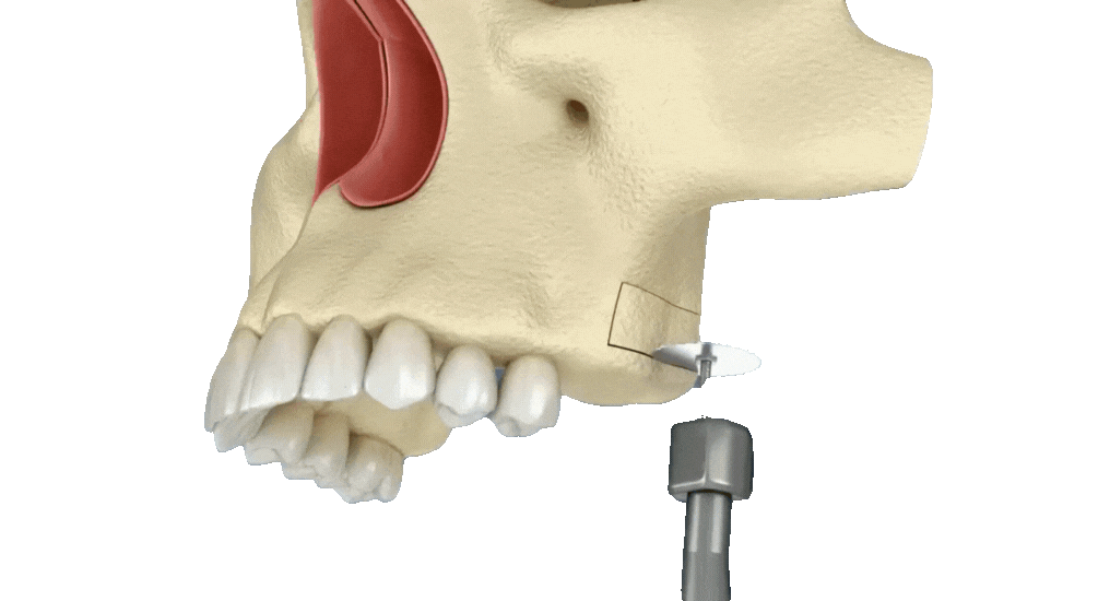 Sinus Lift Surgery 3D Animationat tirana dental center