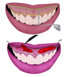 Lip Repositioning Surgery animation Tirana Dental Center