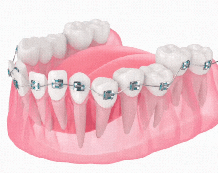 braces 3D animation at tirana dental center