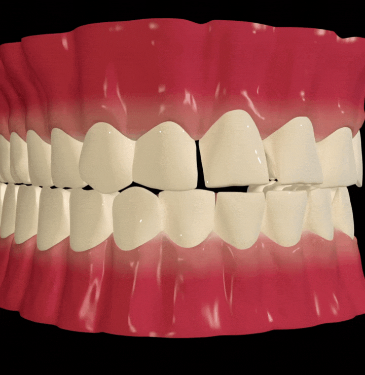 braces step by step tutorial animation at tirana dental center