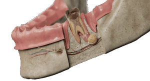 cyst Removal tirana dental center